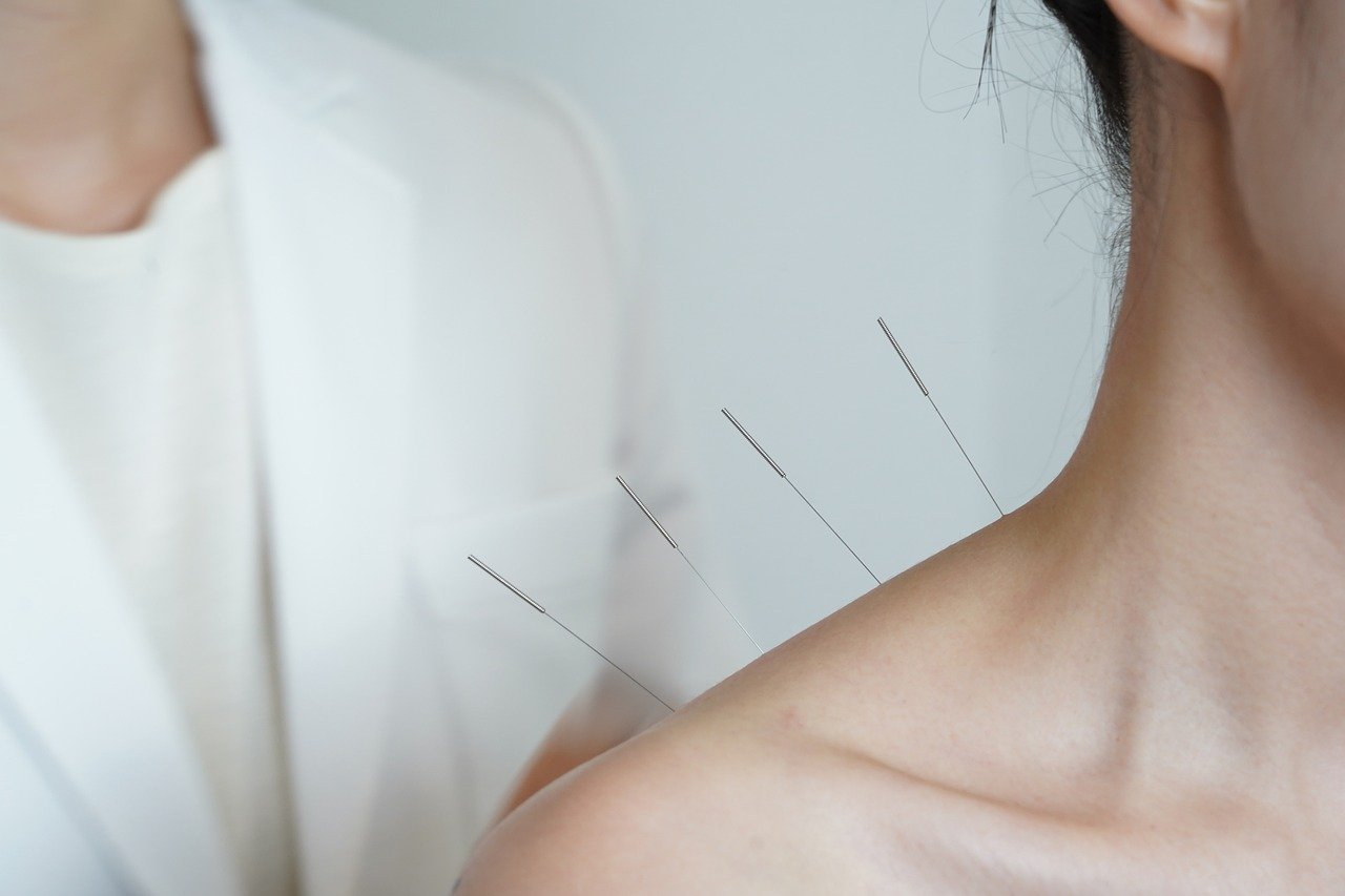 Acupuncture: Ancient Healing, Modern Life